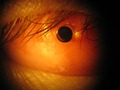 rechtes Auge mit Osteo-Odonto Keratoprothese-Implantat